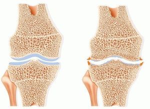 Артрозо-артрит колена