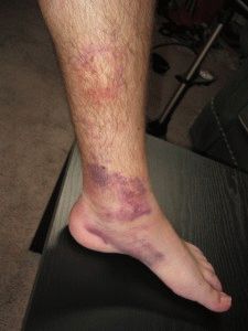 Травма ноги
