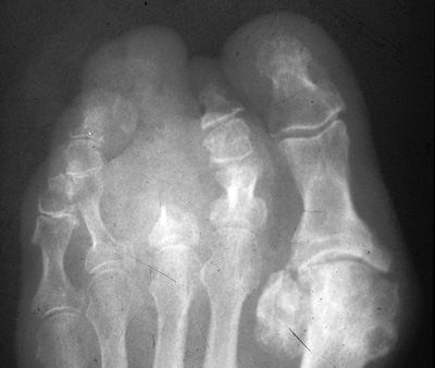 Ногтевой фаланги пальца ноги. Остеома ногтевой фаланги 1 пальца стопы. Остеомиелит фаланг стопы рентген. Остеомиелит пальцев стопы рентген. Остеомиелит ногтевой фаланги 1 пальца стопы.