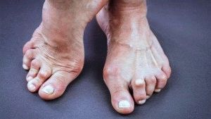 Ревматоидный артрит ног