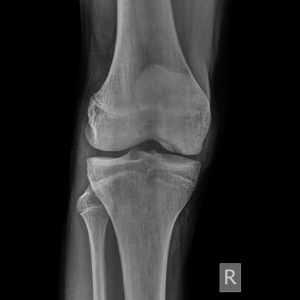 Изображение - Боли около коленного сустава 493-300x300