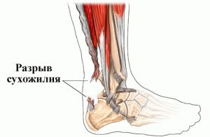 Травма ноги 
