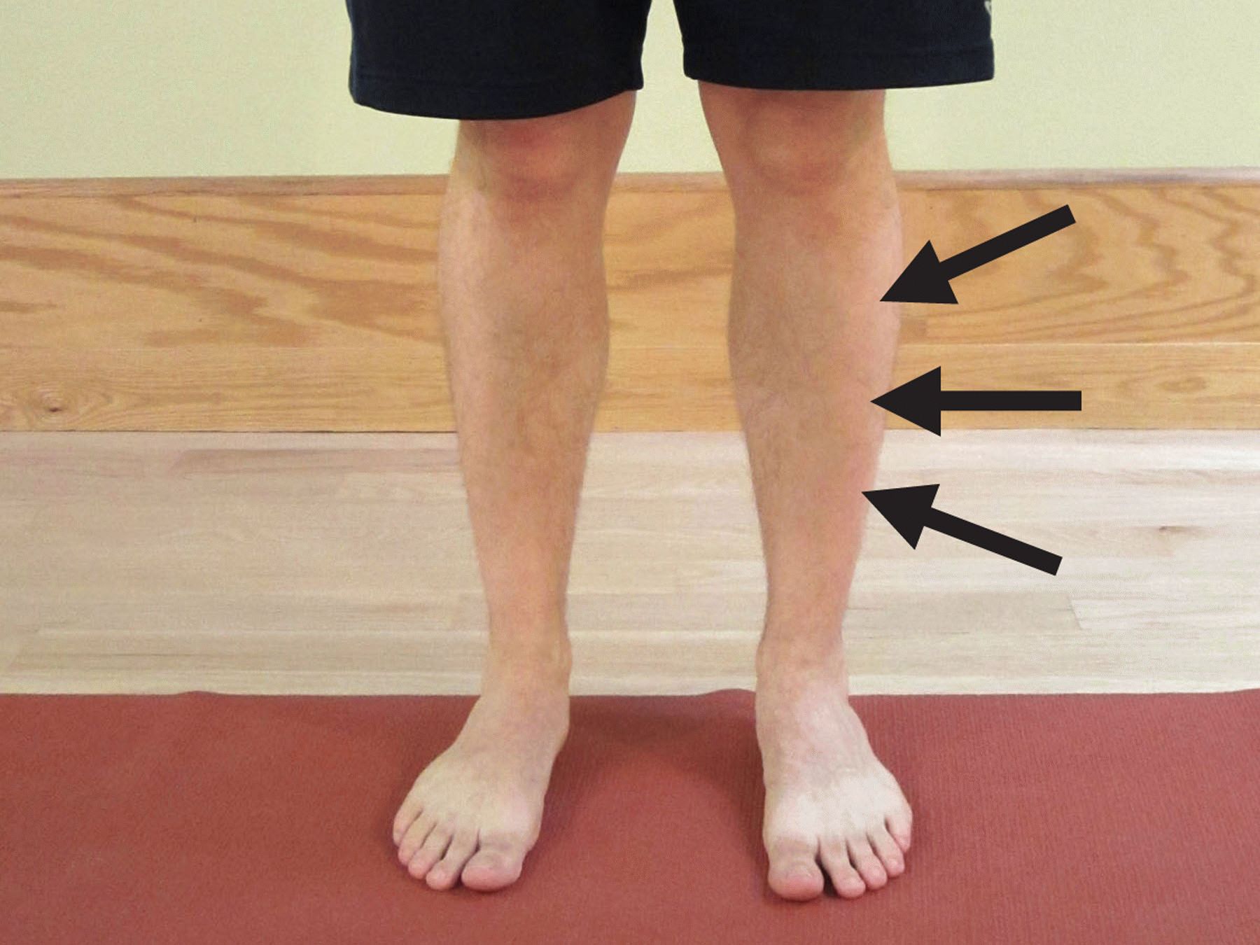 Сильные боли ноги ниже колена причины. Наружная сторона голени. Голень ноги. Ногоболт.