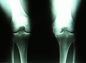 Изображение - Деформирующий остеоартроз 3 степени коленного сустава 15.1-300x221
