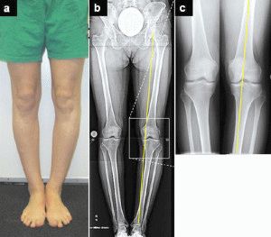 Изображение - Деформирующий остеоартроз коленного сустава 2 3 степени 15.2-300x263