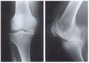 Изображение - Деформирующий остеоартроз коленного сустава 2 3 степени 15.3-300x214