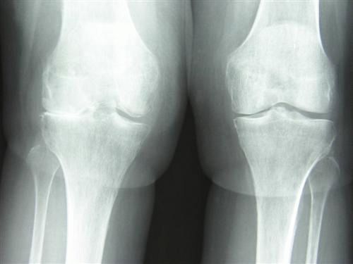 Сустав 1а. Патология коленного сустава. Гонартроз 2 степени фото. Патология коленного сустава фото.