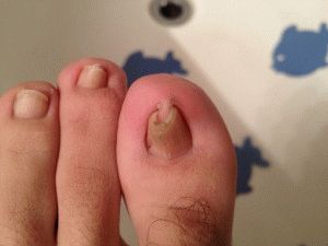 Искривление ногтей на ногах