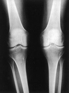 Деформирующий остеоартроз коленного сустава 2 степени лечение