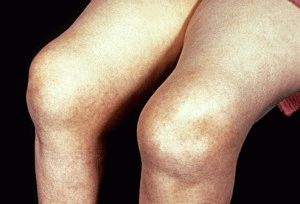 Деформирующий остеоартроз коленного сустава 2 степени лечение