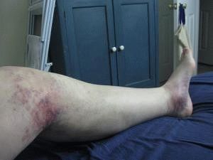 Травма ноги