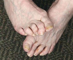 Деформируются пальчики ног