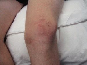 Чем лечить коленные суставы