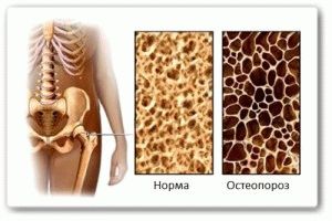 Остеопороз как причина