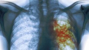 Туберкулёз влияет на болезнь