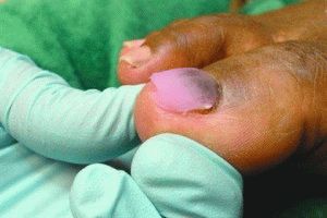 Повреждение ногтя