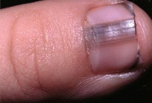 Меланома ногтевой пластины