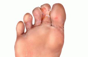 Шелушение между пальцами ног