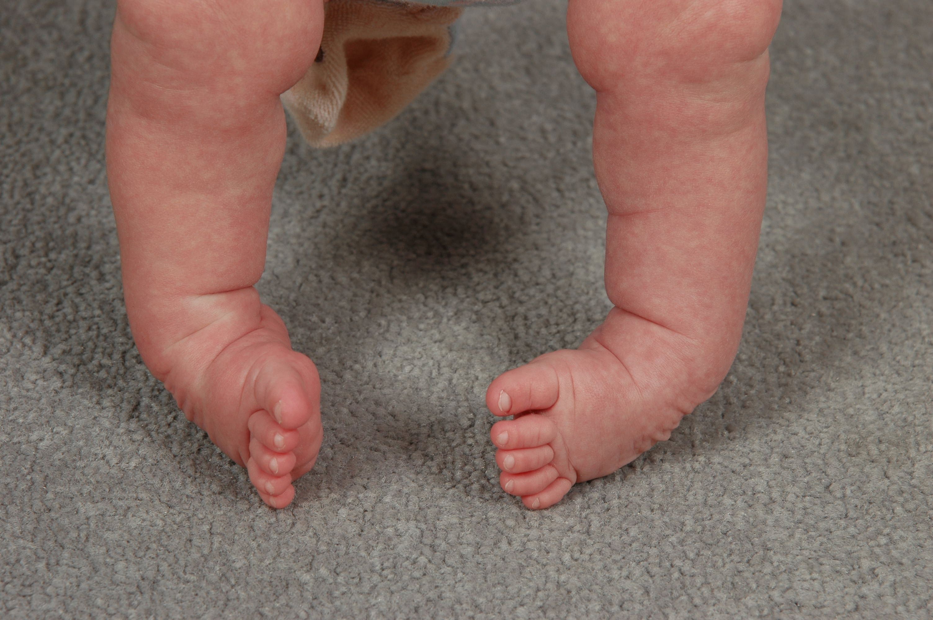 Почему дети поджимают ноги. Врожденная эквиноварусная косолапость. Врождённая косолапость новорожденного. Эквиноварусная косолапость у новорожденных. Двухсторонняя врожденная косолапость.
