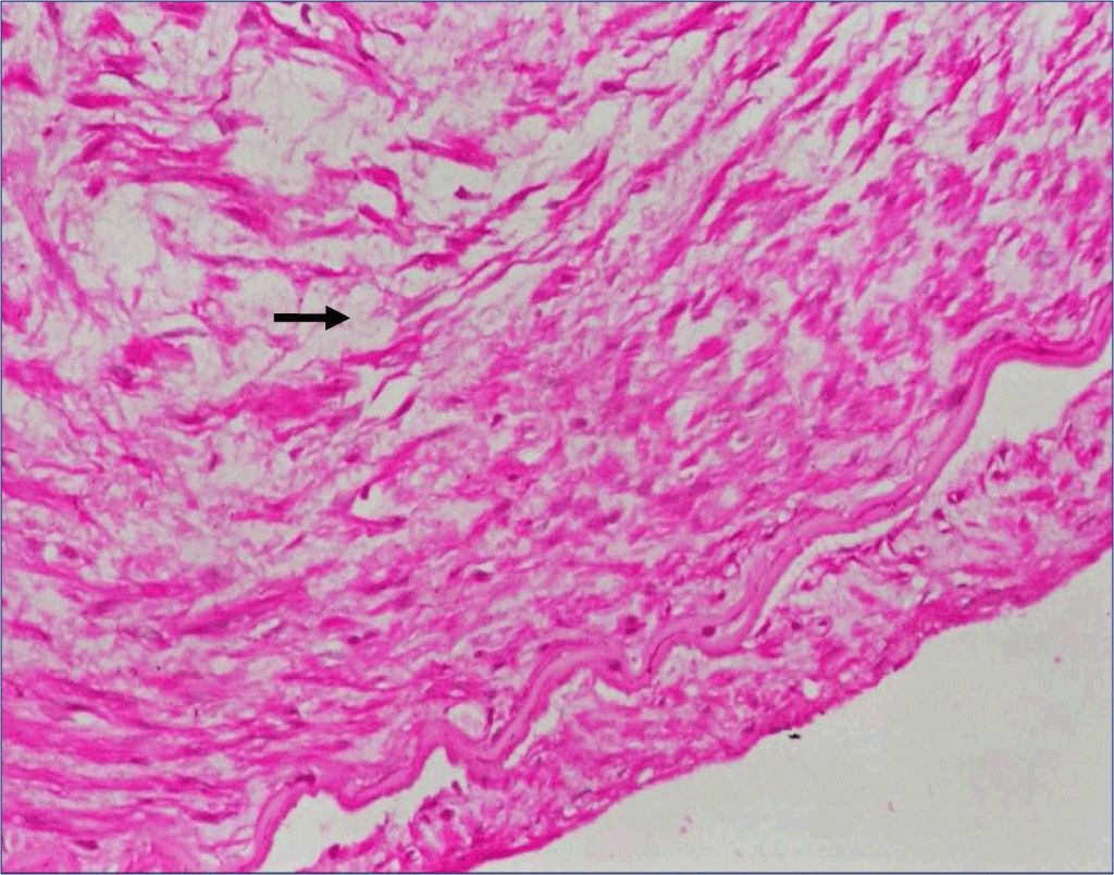 Дисплазия соединительной ткани: виды, симптомы и особенности