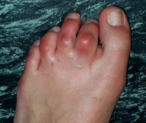 Воспаление сустава большого пальца ноги лечение