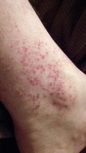 Зуд ног от аллергии