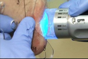 Лазерное лечение псориаза