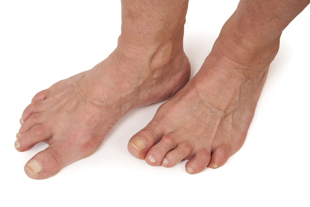 Болит большой палец ноги при ходьбе. Ревматоидный артрит плюснефалангового. Ревматоидный артрит суставов стопы. Подагрический артрит плюснефалангового сустава. Деформирующий артроз суставов стопы.